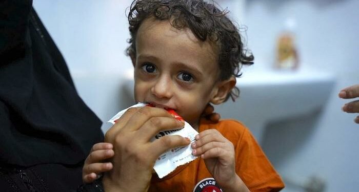 Acute Malnutrition Surges In Yemen